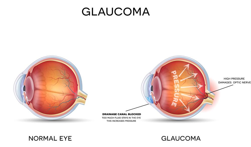 Early Signs Of Glaucoma Image