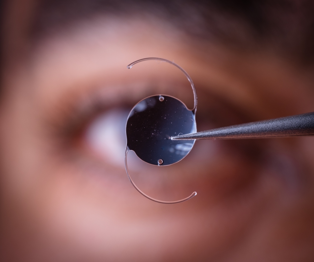 Customizing Cataract Surgery: How Light Adjustable Implants Work Image